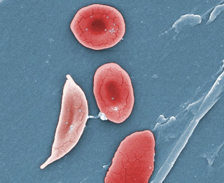 This 2009 colorized microscope image shows a sickle cell, left, and normal red blood cells of a patient with sickle cell anemia. Credit: Tribune News Service/Sickle Cell Foundation of Georgia
